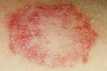 જી. કે. જન. અદાણી હોસ્પિ. નાં સ્કિન વિભાગમાં આવતા દર્દીઓ પૈકી ૬૦ ટકા ફંગલ ચેપ&nbsp;ગ્રસ્ત