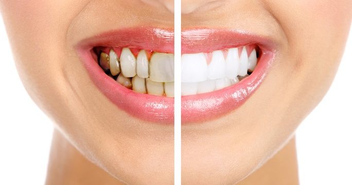 જી. કે. જન હોસ્પિટલના પેરિયોડેન્ટિસ્ટ અને દંત ચિકિત્સકોએ દાંત અને પેઢાના રોગ સામે લોકોને કર્યા&nbsp;જાગૃત